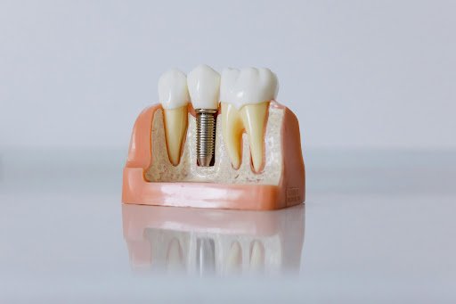 Pinnacle Periodontics & Dental Implants